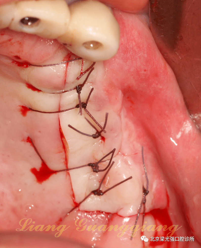 牙医学堂上颌窦膜破裂后二次种植