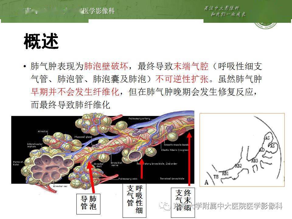 胸部丨肺气肿的ct诊断及相关鉴别诊断