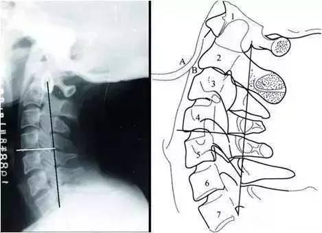 頸椎x線閱片速診口訣及閱片重點彙總