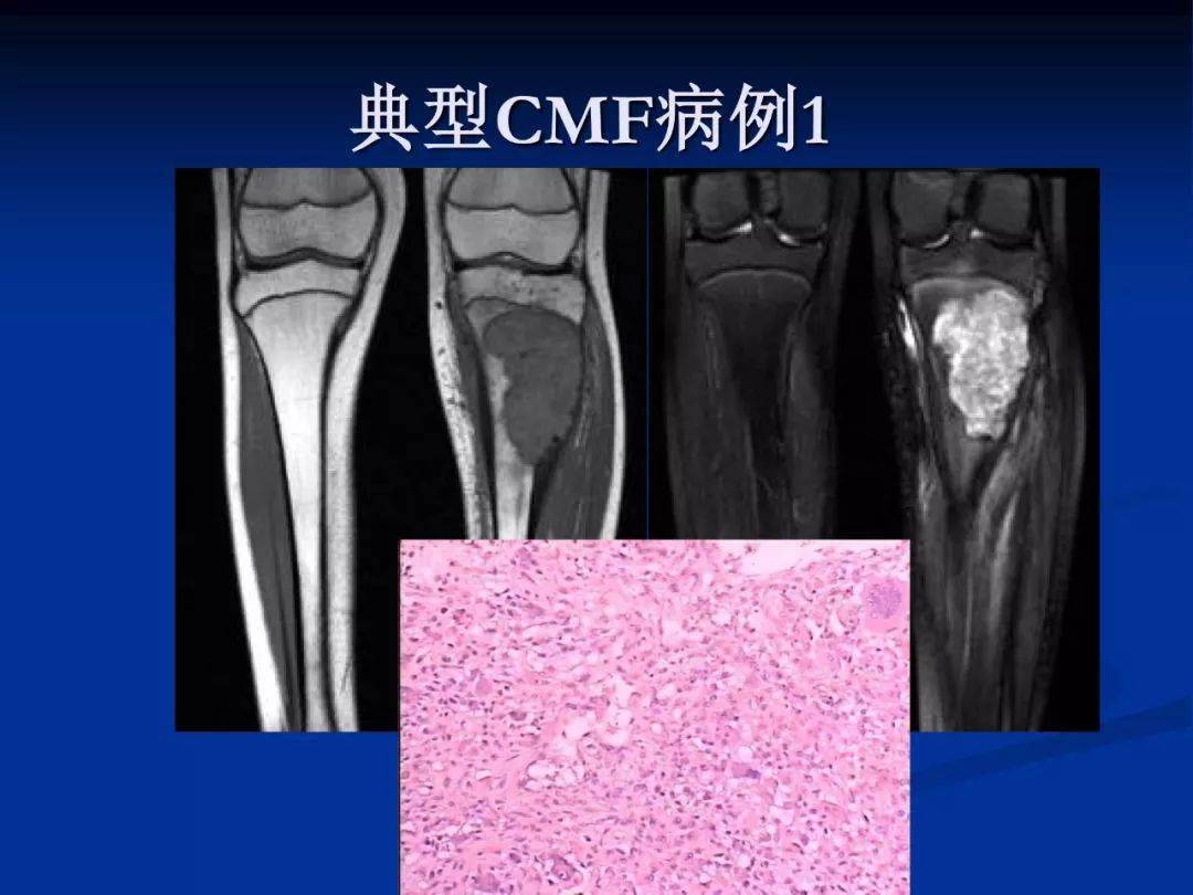 软骨粘液样纤维瘤影像学诊断