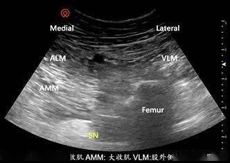 瑞金超聲專題超聲引導下坐骨神經阻滯