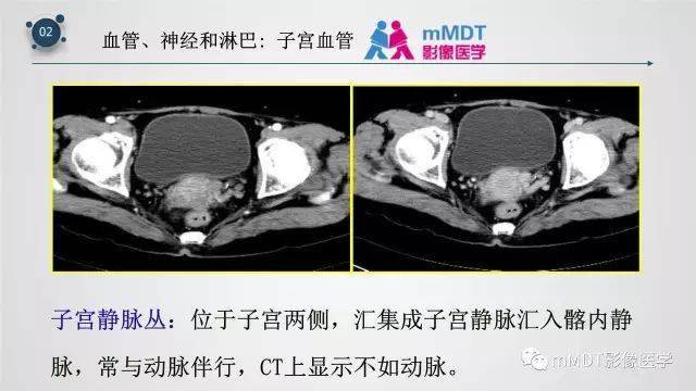 子宫附件影像解剖