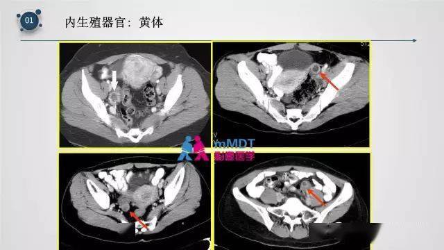 子宫附件影像解剖