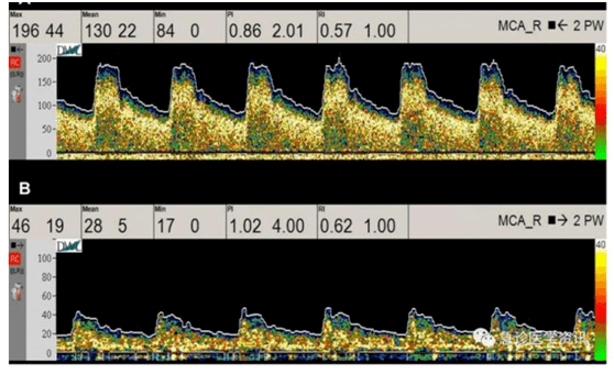 珠江视界张丽娜教授围术期神经重症患者的重症管理关注脑血流