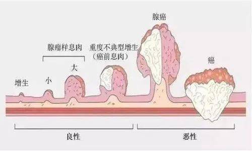 外阴舌状息肉图片