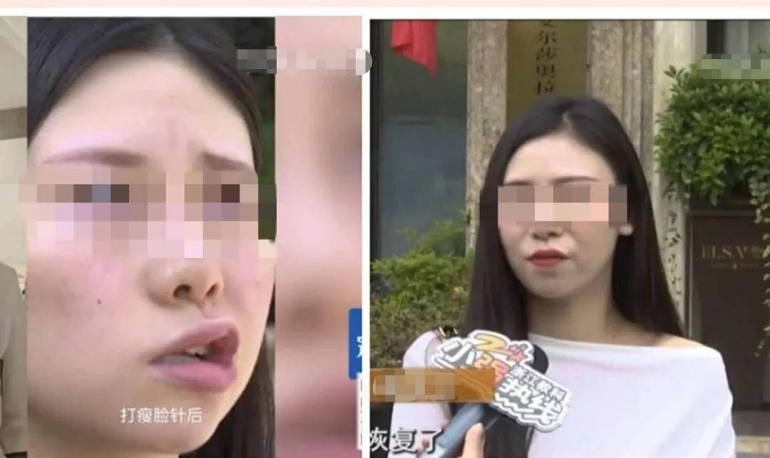 29歲姑娘打瘦臉針後突然面癱本以為要終身毀容幸好靠它挽回顏面