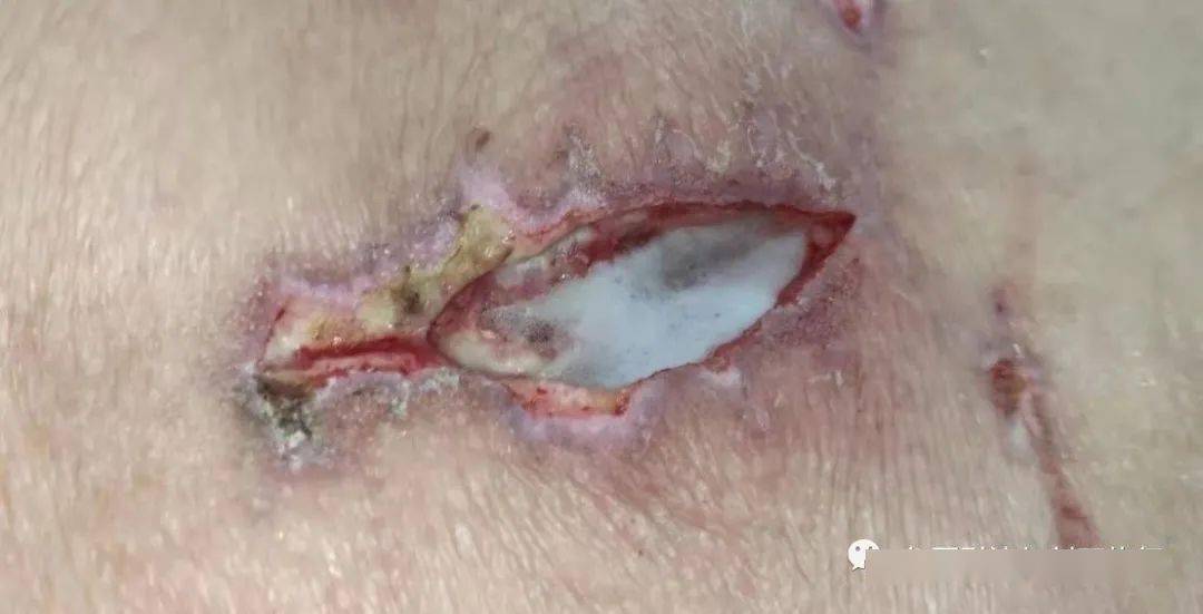 双氧水的"毒",深入人"心",再不注意你也会犯_伤口