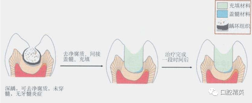 深龋的治疗