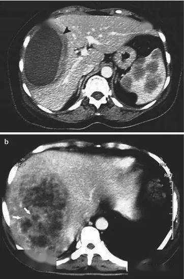 369.hepatic abscesses
