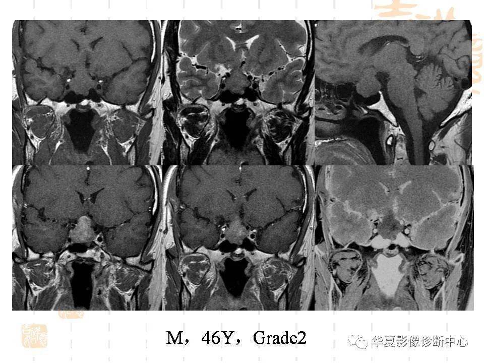 侵襲性垂體瘤的mri徵象
