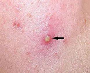 润禾科普毛囊炎的症状有哪些皮肤出现2个症状警惕毛囊炎