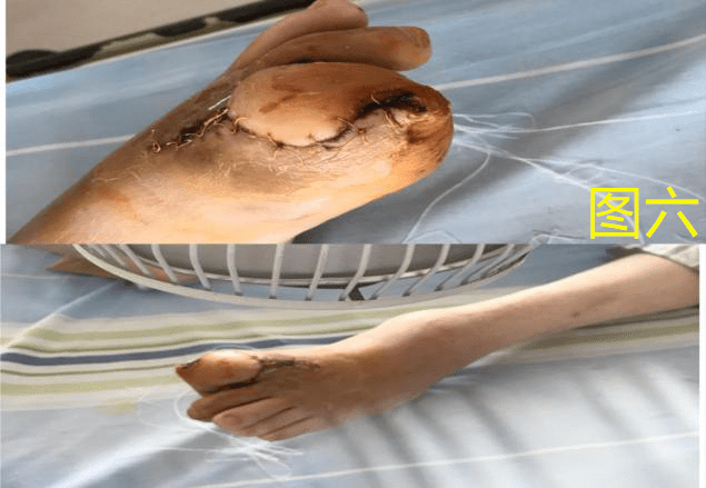 糖尿病足溃疡患者的死亡率达10%,糖尿病足后截肢患者的死亡率达20%