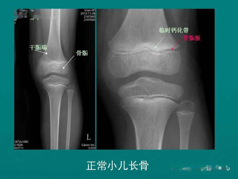 四肢骨骼正常影像解剖