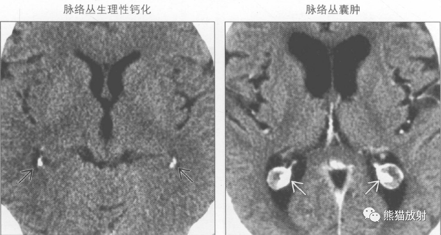 订阅 点击查看更多订阅内容> 鉴别诊断 常见 脉络丛生理性钙化 脉络丛