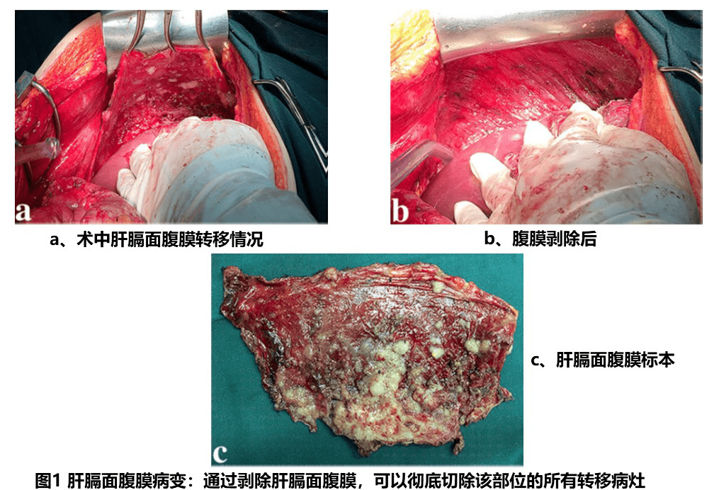 初治卵巢癌手术——如何打扫腹腔的天花板和地板?