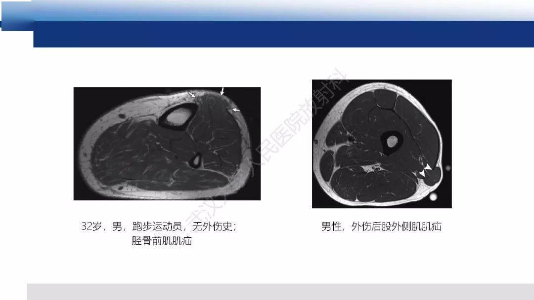 肌肉创伤mr诊断:解剖,生物力学,病理生理学及影像学表现