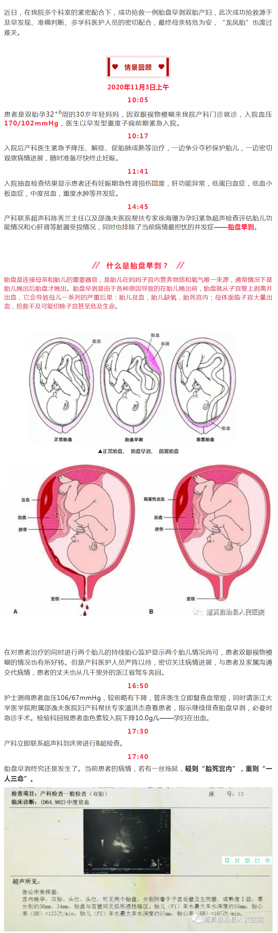 道真一雙胎孕婦突發