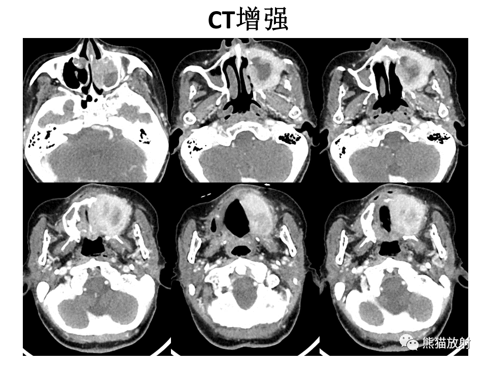 下頜骨鱗狀細胞癌,牙齦鱗狀細胞癌返回搜狐,查看更多