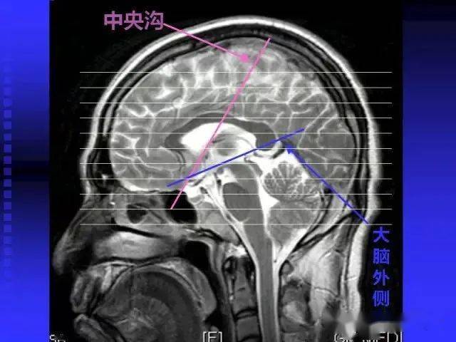 颅脑mri矢状位解剖图图片