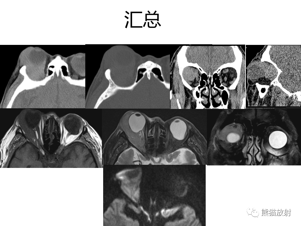 【省立影像讀片】眼眶病變 20.11_解剖