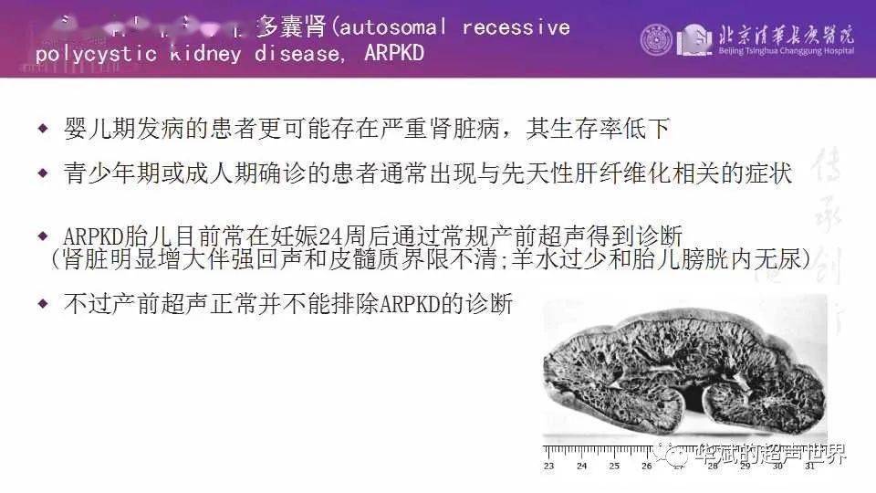 病例讨论与文献学习caroli病caroli综合征