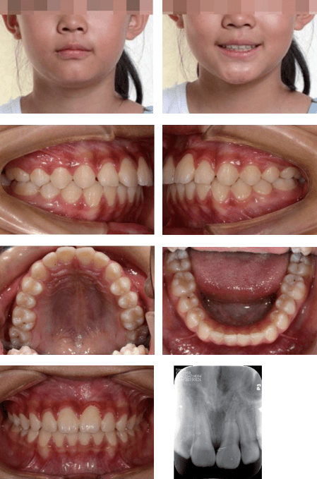 埋伏阻生弯曲中切牙的多学科治疗——王秀婧副主任医师_牙根
