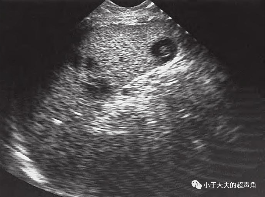 超声随响第27期肝念珠菌病candidiasis