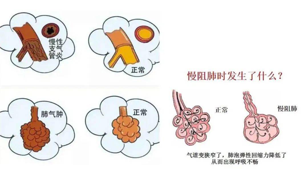 【徐水妇幼健康管理】改善慢阻肺生活,关系你我健康