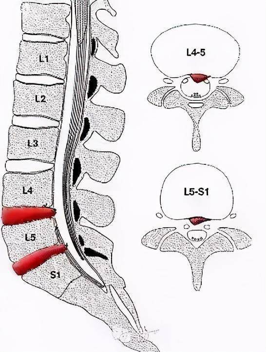 腰椎4-5椎间盘膨出图片