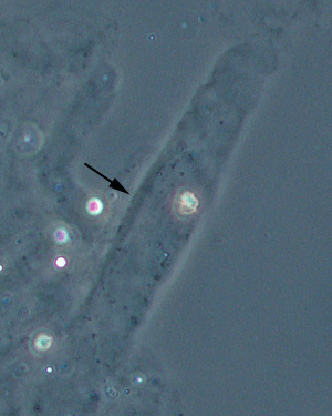 尿检管型到底有什么意义一次性讲透管型成分形成原理和6种管型