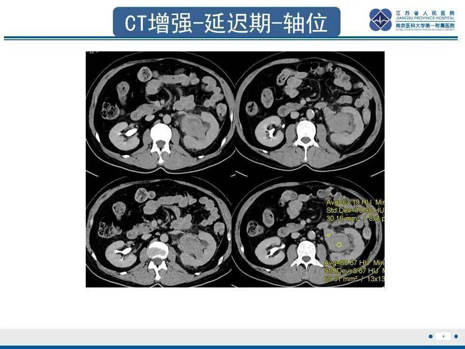 每日一例1198肾盂癌影像学分型与表现