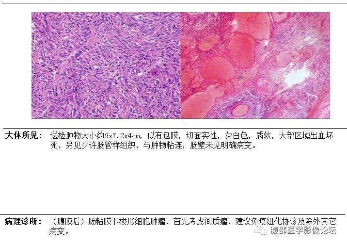 腹膜后丨间质瘤