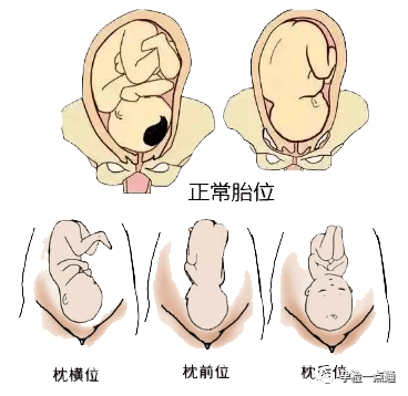 胎儿头位是什么意思图片