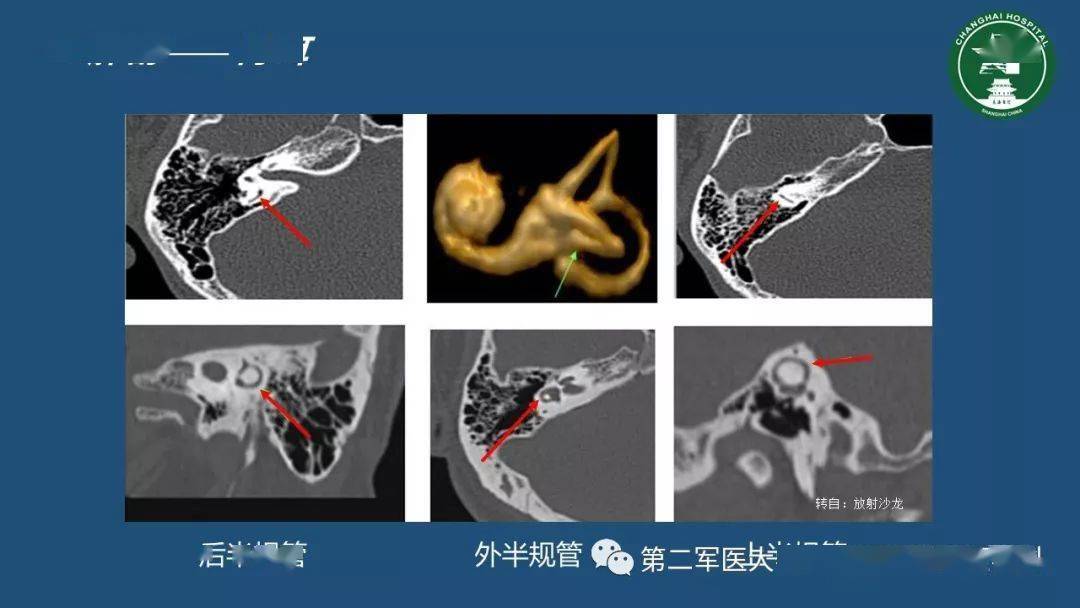 顳骨ct解剖及其常見病變