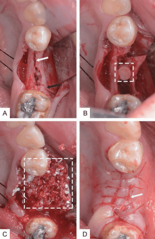 骨劈开联合骨块inlay技术对下颌后牙区软硬组织的影响郭泽鸿副主任