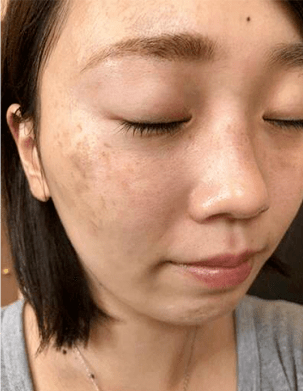 无论你"色斑"有多久,这个新方法,50岁前都有救