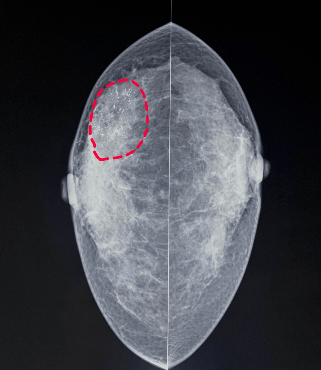 乳腺恶性肿瘤的微小钙化在病理生理上归属于营养不良性钙化,是恶性