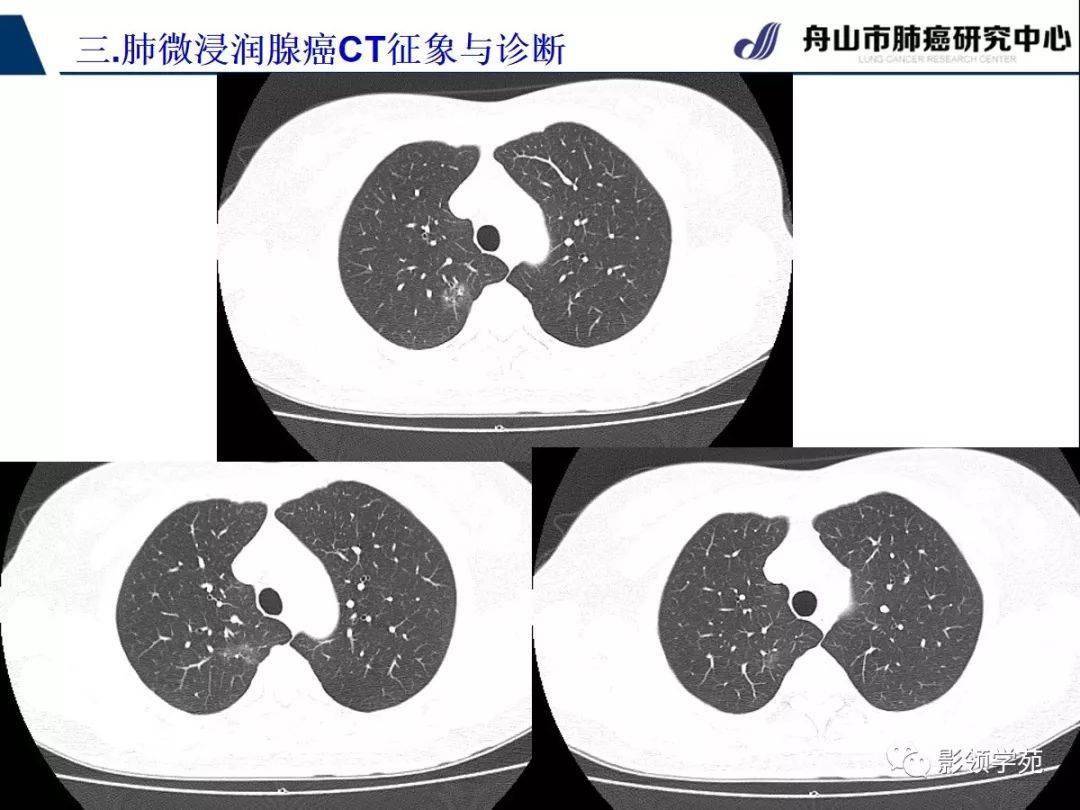 微浸润肺腺癌(mia)
