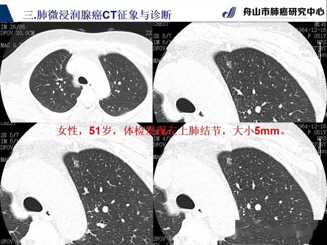 微浸润肺腺癌(mia)