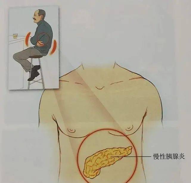 发展到最后,甚至会造成胰腺癌和糖尿病.