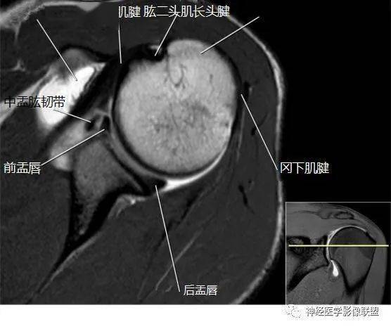 肩关节韧带mri解剖图图片