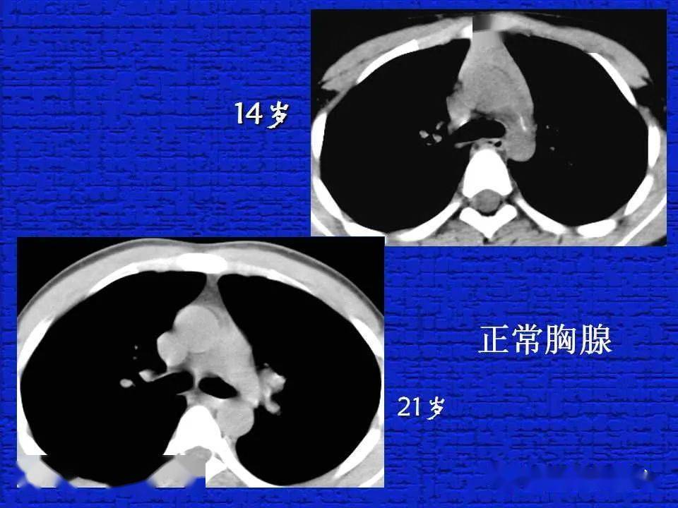 结合解剖谈正常胸部CT读片-搜狐大视野-搜狐新闻