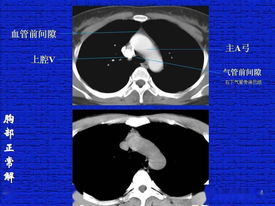 结合解剖谈正常胸部CT读片-搜狐大视野-搜狐新闻