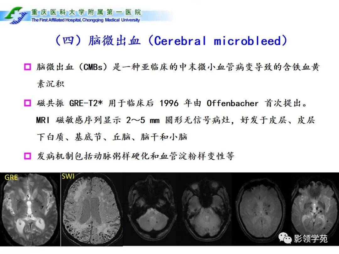 脑小血管病的影像学诊断