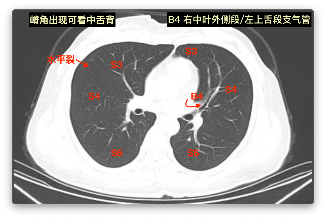 左肺下叶前内基底段图片