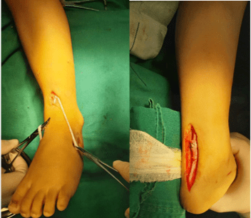 宝宝生下来时脚是歪的八成是这个病先天性马蹄内翻足