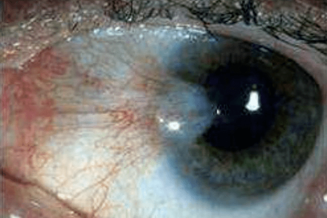 问日常门诊中,也会碰到很多患者把睑裂斑误认为是翼状胬肉"鱼肉"的