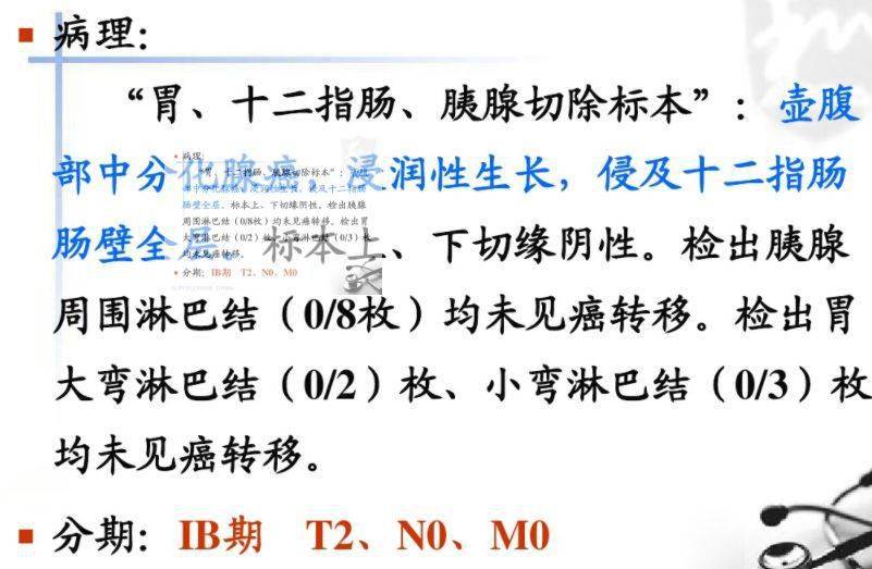 胰頭部低密度腫物;侵襲壺腹部可見膽總管,胰管擴張十二指腸癌:十二