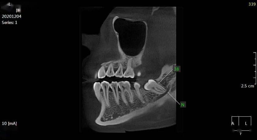 田xx20201205智齒cbct152xxxx0672