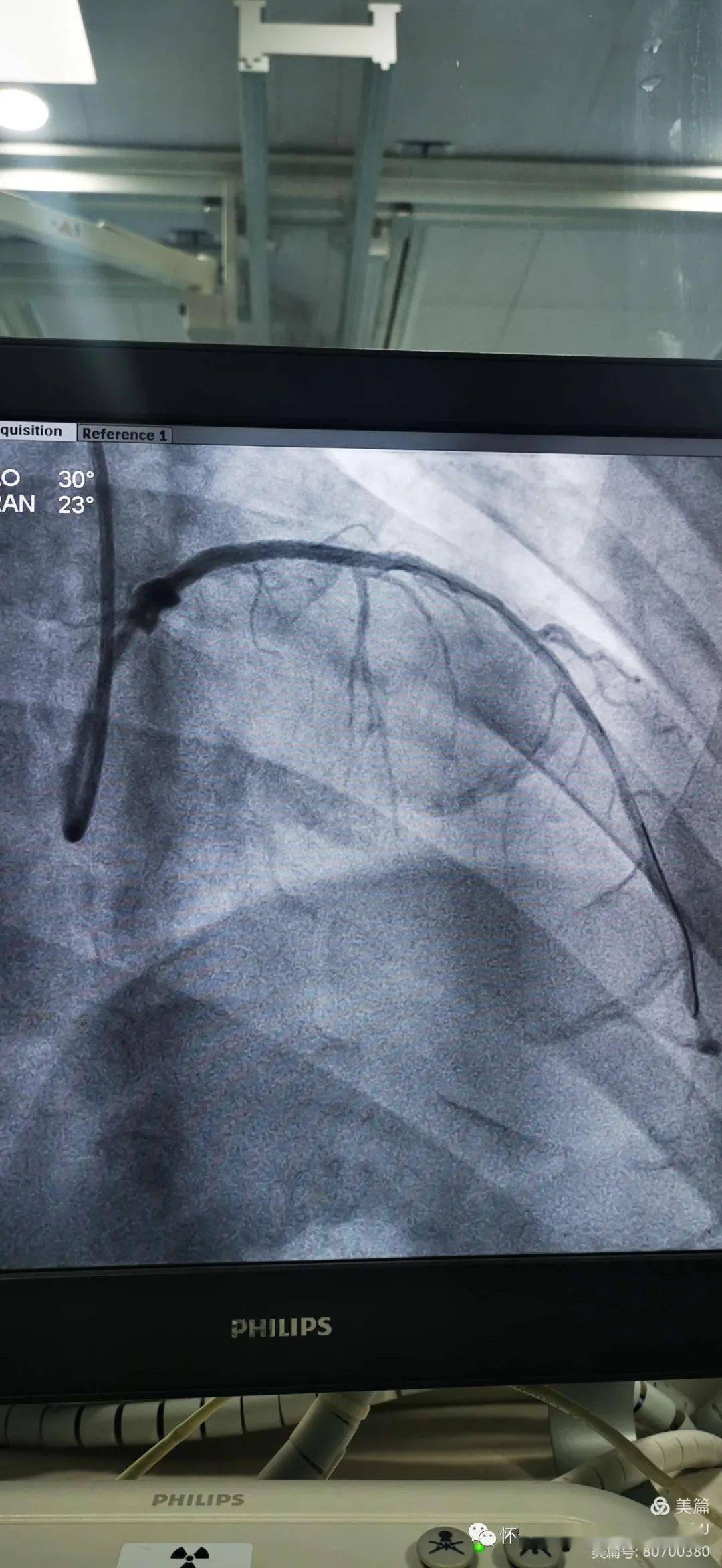 【特别关注】怀仁市人民医院介入导管室完成冠脉造影11例,支架植入2例